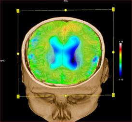 TEP cérébral au 18-FDG - Sinem